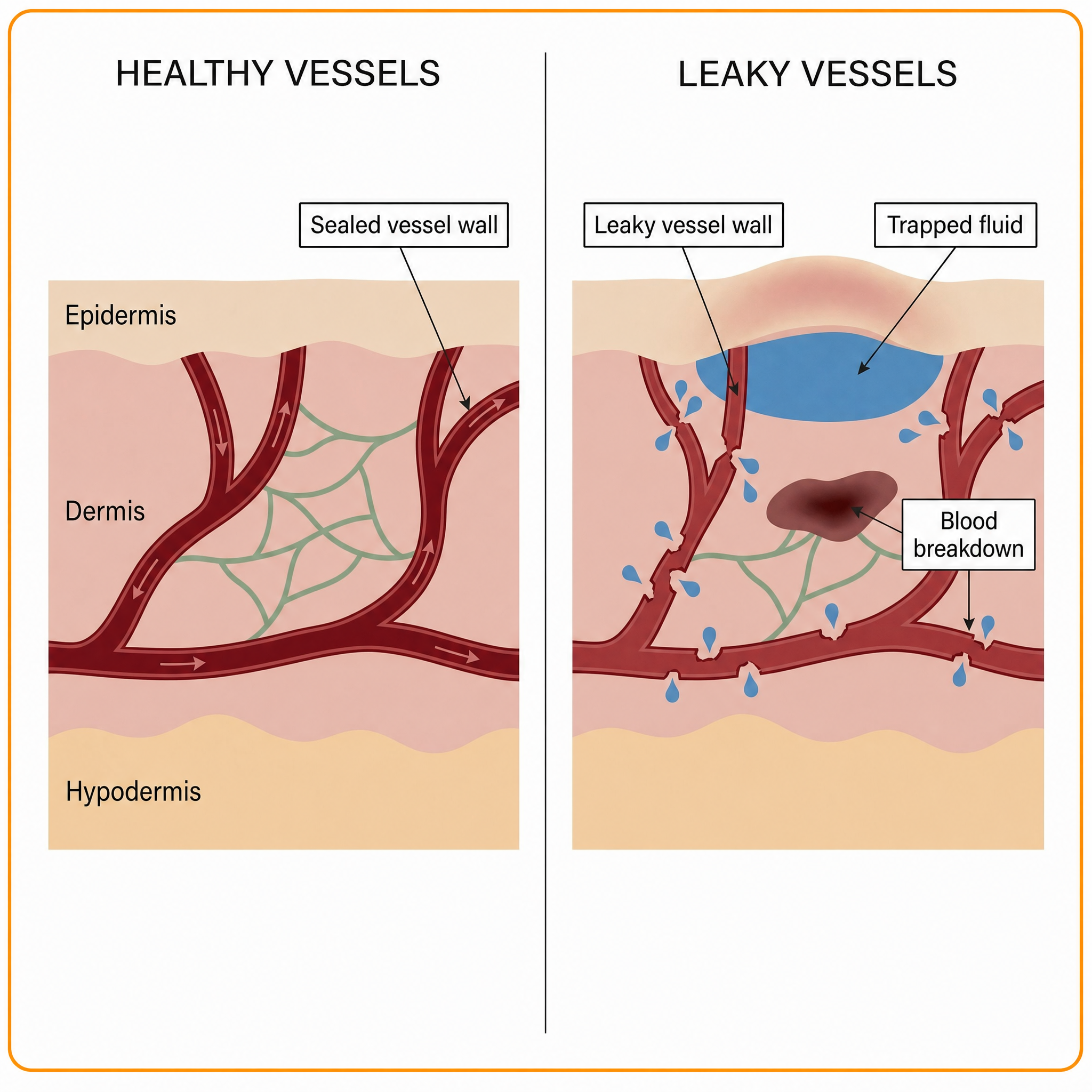 How leaky vessels cause under-eye bags and dark circles